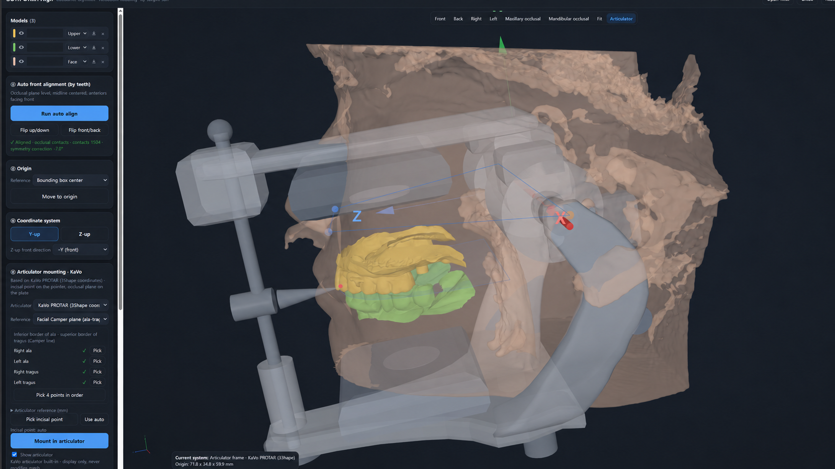 SUHFORM Align development screenshot showing facial reference points, upper and lower scans, and virtual articulator mounting